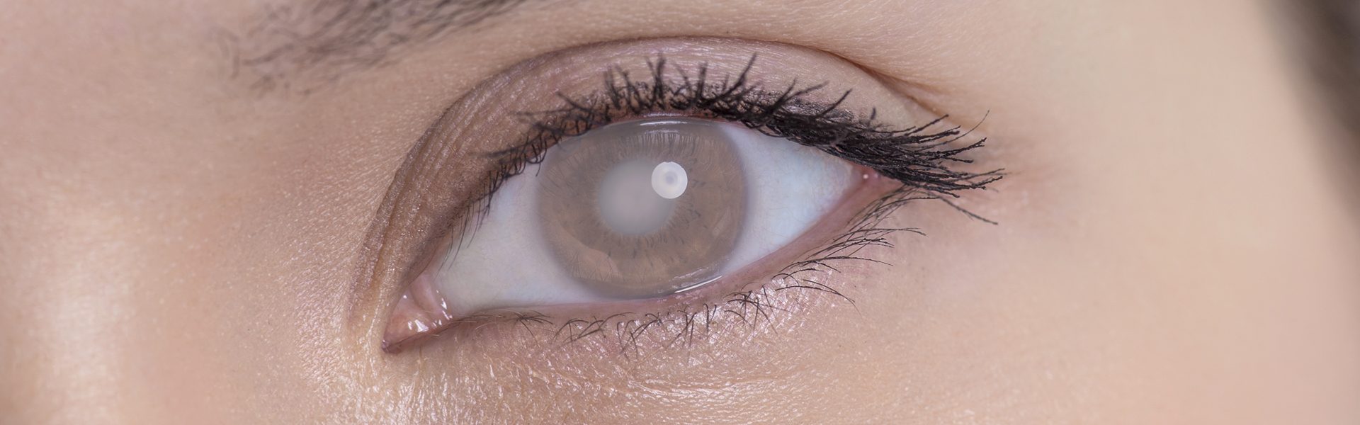 What You Should Know About Cataracts and Cataract Surgery